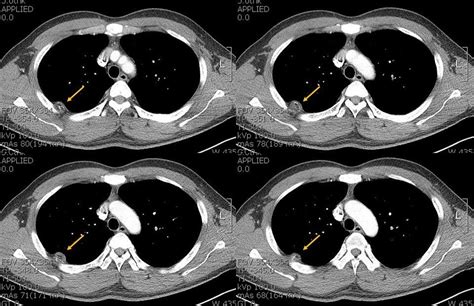 Well Circumscribed Type Of Intramuscular Lipoma In The Chest Wall