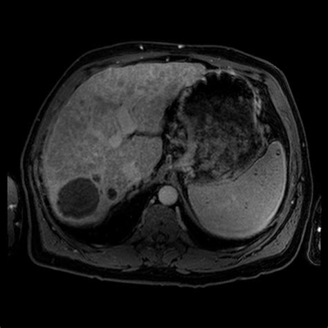 Fatty Liver With Areas Of Sparing Liver Case Studies Ctisus Ct