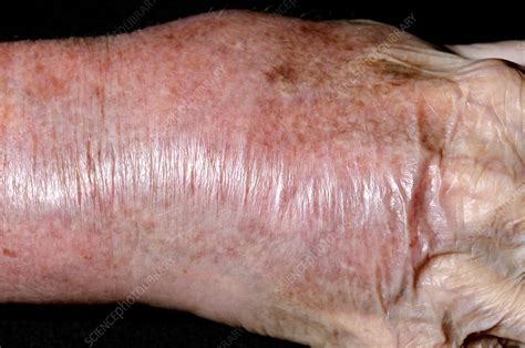 Cellulitis Of The Wrist Stock Image C0167232 Science Photo Library