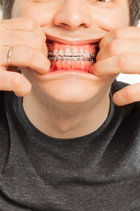 How To Deal With Pain From Braces Trackreply4