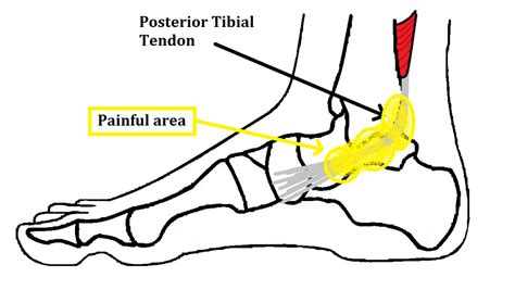 Posterior Tibial Tendonitis Brace