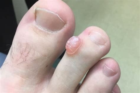 Clinical Challenge Growth On The Second Toe Mpr