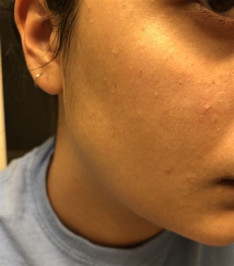 Little White Spots On Skin