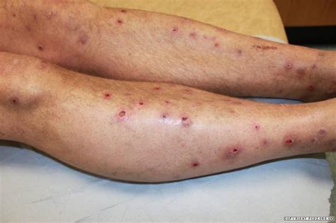 De tijgermug wordt sinds de zomer van 2005 ook gesignaleerd in nederland, maar het is niet duidelijk of de soort zich hier blijvend heeft gevestigd als. Prurigo | Primary Care Dermatology Society | UK