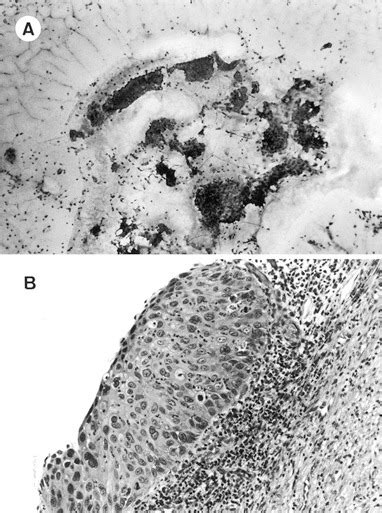 Early Acquisition Of Gelatinolytic Activity In Carcinogenesis Of The Uterine Cervix Modern