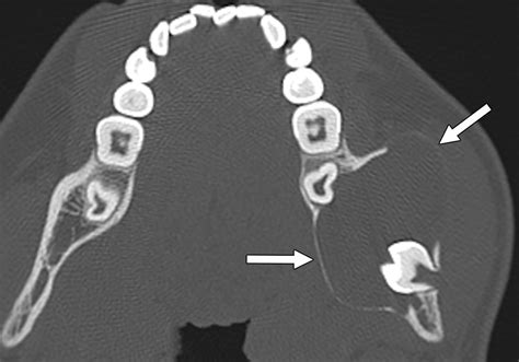 Focal Benign Disorders Of The Pediatric Mandible With Radiologic