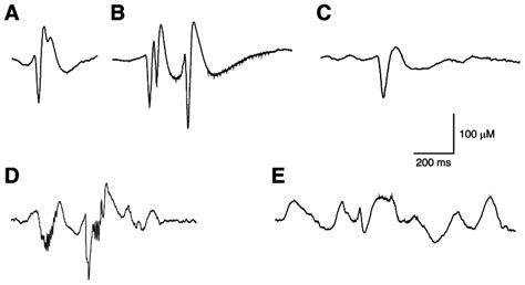 Figure 1 Interictal Epileptic Discharge Ied Patterns Recorded In