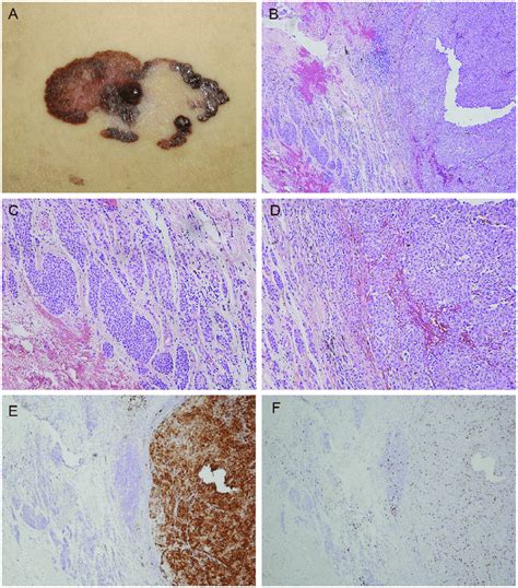 Melanoma Nodular Causas Síntomas Tratamiento Y Más