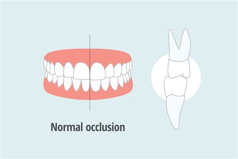 Overbite Vs Normal Bite Differences Causes And Treatment