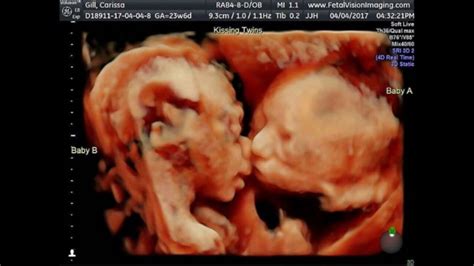 pregnant with twins ultrasound