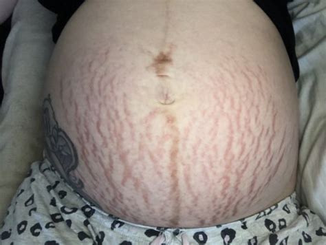 36 Weeks Pregnant With Bad Stretch Marks October 2018