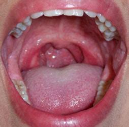 Changes in voice, headaches, sore throat or a cough may be symptoms of throat cancer. Cancer of Larynx (Throat Cancer)-Risk Factors-Symptoms ...