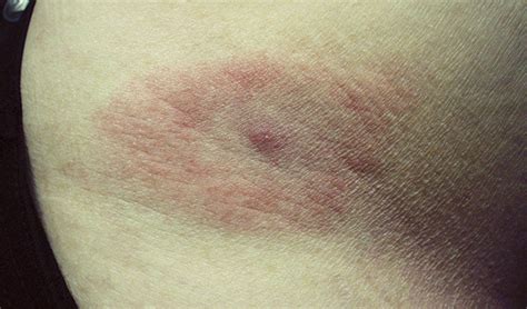 Erythematous Plaques On The Trunk Clinical Advisor