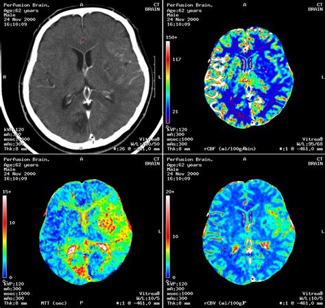 What Is Ct Scan Contrast Dye Made Of Ct Scan Machine