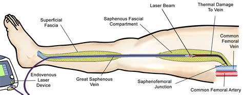 Acd A Z Of Skin Leg Veins
