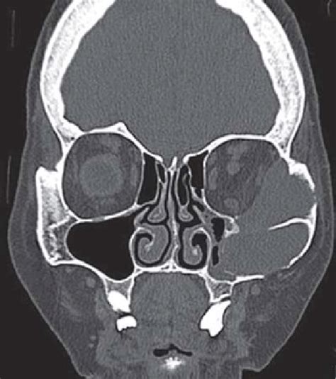CT Scan Coronal Showing Expansile Lytic Mass Lesion In The Left