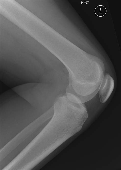 Osgood Schlatter Disease Image