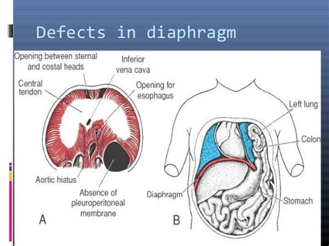 Anaesthetic Implications Of Congenital Diaphragmatic Hernia
