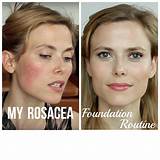 Pictures of Skincare And Makeup For Rosacea