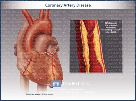 Coronary Artery Disease Trial Exhibits Inc