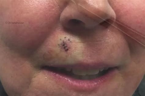 Dr Pimple Popper Squeezes Massive Blackhead Daily Star