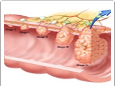 Schematic Depiction Of The Five Tnm Stages Of Colon Cancer Download
