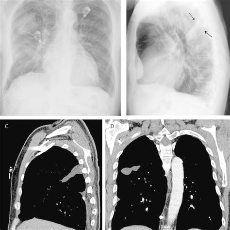 Extrapleural Opacity Hodgkins Lymphoma Of The Rib Cage Frontal Chest