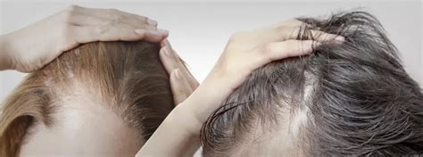 Greffe de Cheveux Tunisie : Prix et techniques implants