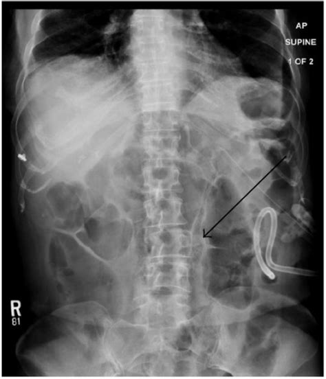 Abdominal Radiograph Demonstrates Gastrostomy Tube And Open I