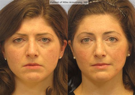 Cat eye botox brow lift before and after. Brow And Forehead Lifts | Richmond Facial Plastics