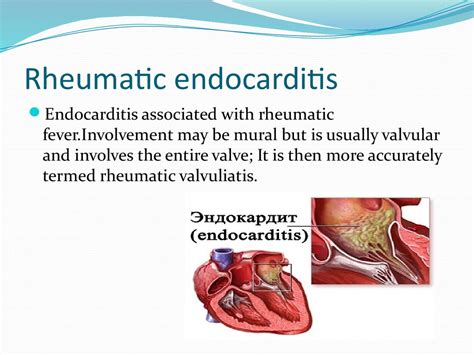 Rheumatic Endocarditis презентация онлайн
