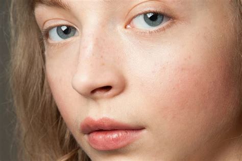 Sensitive Skin What Causes It And The Best Way To Treat It The