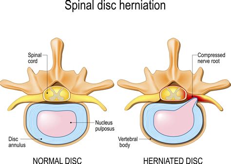 Same with the lumbar because they don't have to work with the. Cervical Disc Herniation | Upswing Health