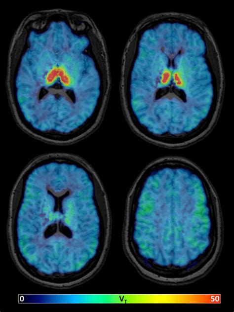 New Nuclear Medicine Tracer Will Help Study The Aging Brain Research