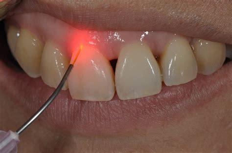 Medical Laser For Endodontics And Periodontics