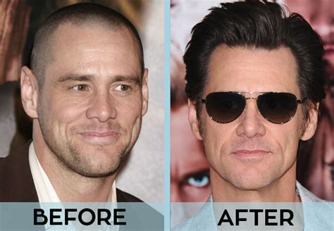31 Celebrities With Hair Transplant Before And After Photos
