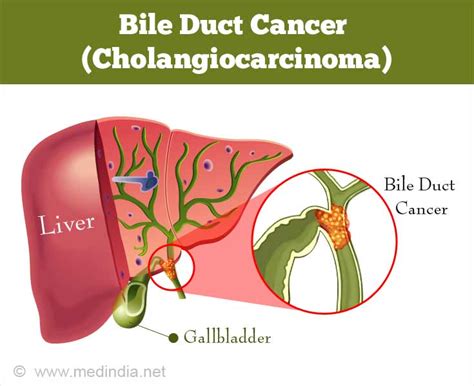 People with gallbladder cancer may experience the following symptoms or signs. Now cancer can be quickly detected — Steemit