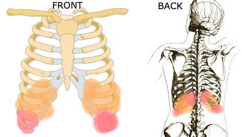 Costochondritis Symptoms Treatment And Chest Pain Cause Herbal Care