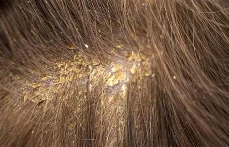 What Causes Scalp Acne And How To Treat It Healthy Mens