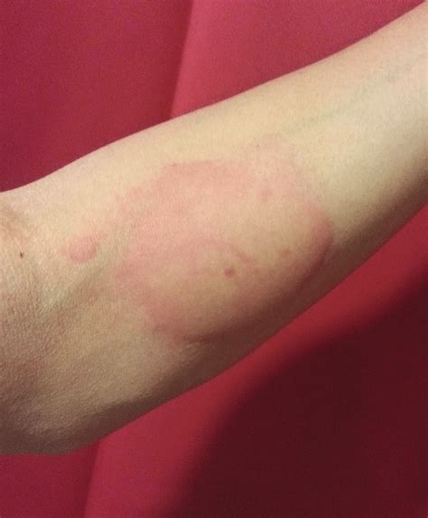 Wheals And Erythematous Papules Three In A Row From Bed Bug Bites