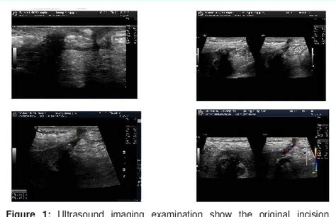 PDF Cholecystocutaneous Fistula After Cholecystectomy Semantic Scholar