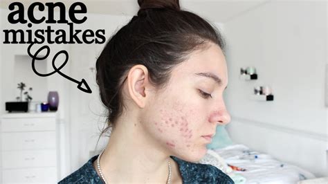 10 Skincare Mistakes Youre Making That Make Your Acne Worse Youtube