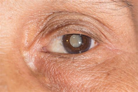 Cataracts Winnipeg Manitoba Optometrist