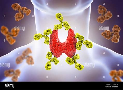 Autoimmune Thyroiditis Hashimotos Disease Conceptual Illustration