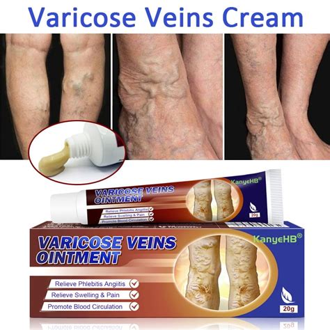 Buy 20g Varicose Veins Cream For Phlebitis Angiitis Inflammation