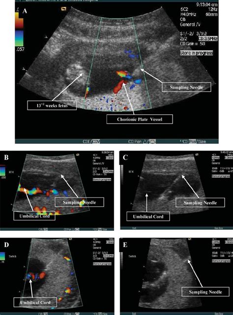 A Ultrasound Guided Fbs Of Chorionic Plate Vessels Close To The
