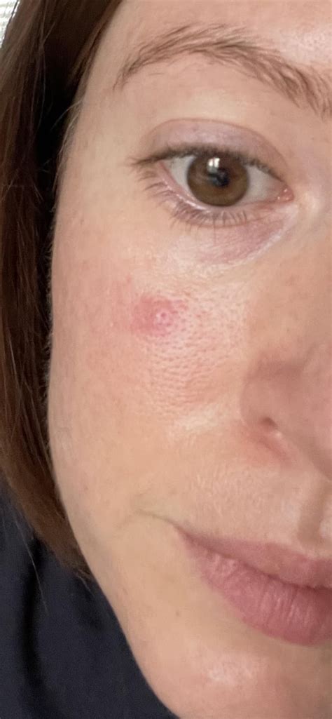 Red Spot On Face Not Going Away Any Recommendations Or Advice R