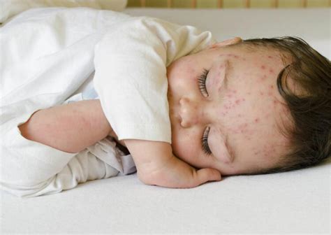 Heres How To Treat Skin Rashes In Babies We Cater