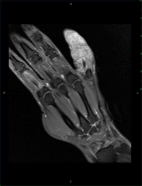 Giant Cell Tumor Of The Tendon Sheath Hand Musculoskeletal Case
