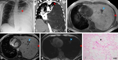 Imaging And Clinical Findings In A Series Of Six Cases Of Rare Primary